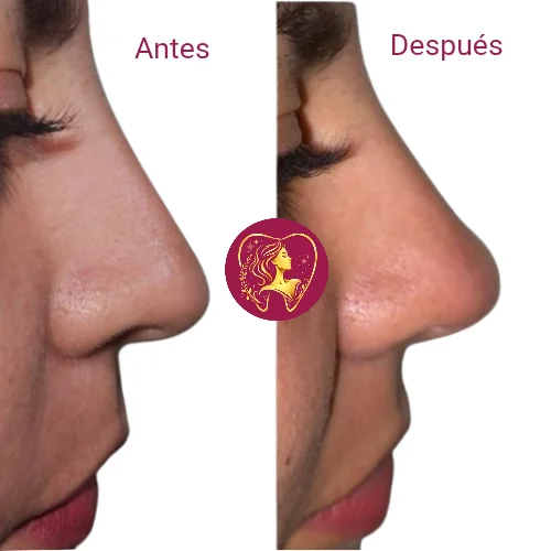Antes y después 1