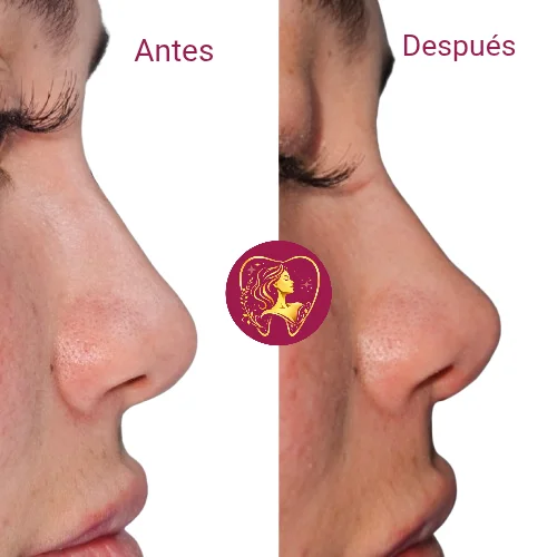 Antes y después 4
