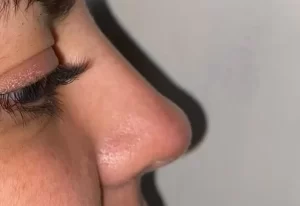 rinomodelacion_dra_camila_carvajal_barraza
